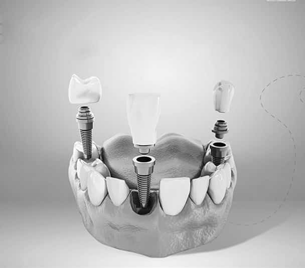Dentus perfectus - implantati - stomatološka ordinacija