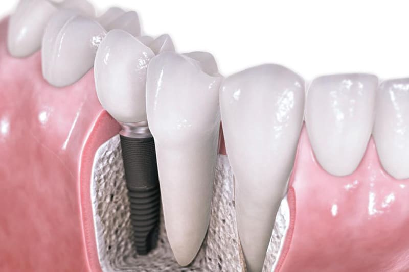 Dentus perfectus - dental implants