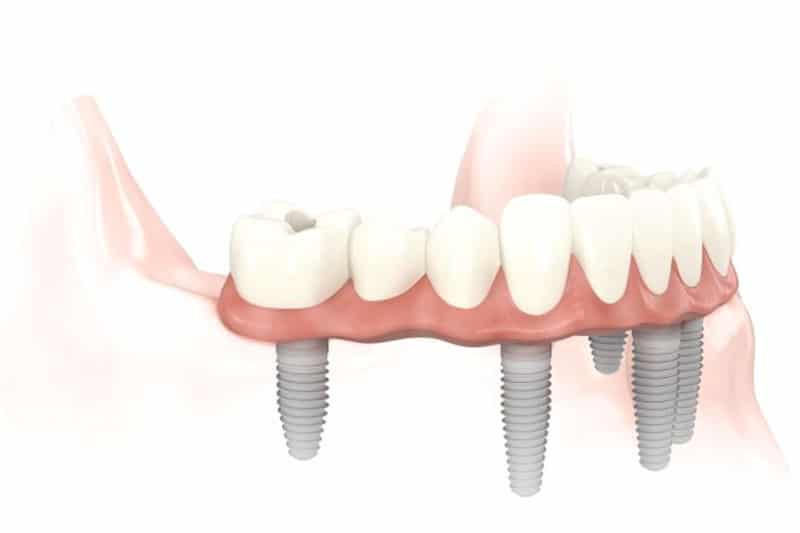 Dentus perfectus - implantologija - all on 6