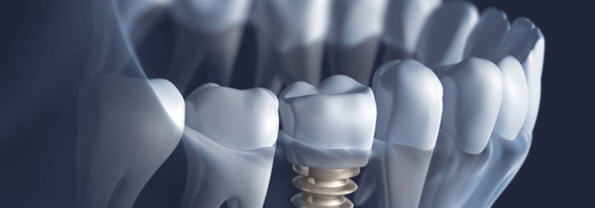 Dentus perfectus - implantologija - što su zubni implantati?