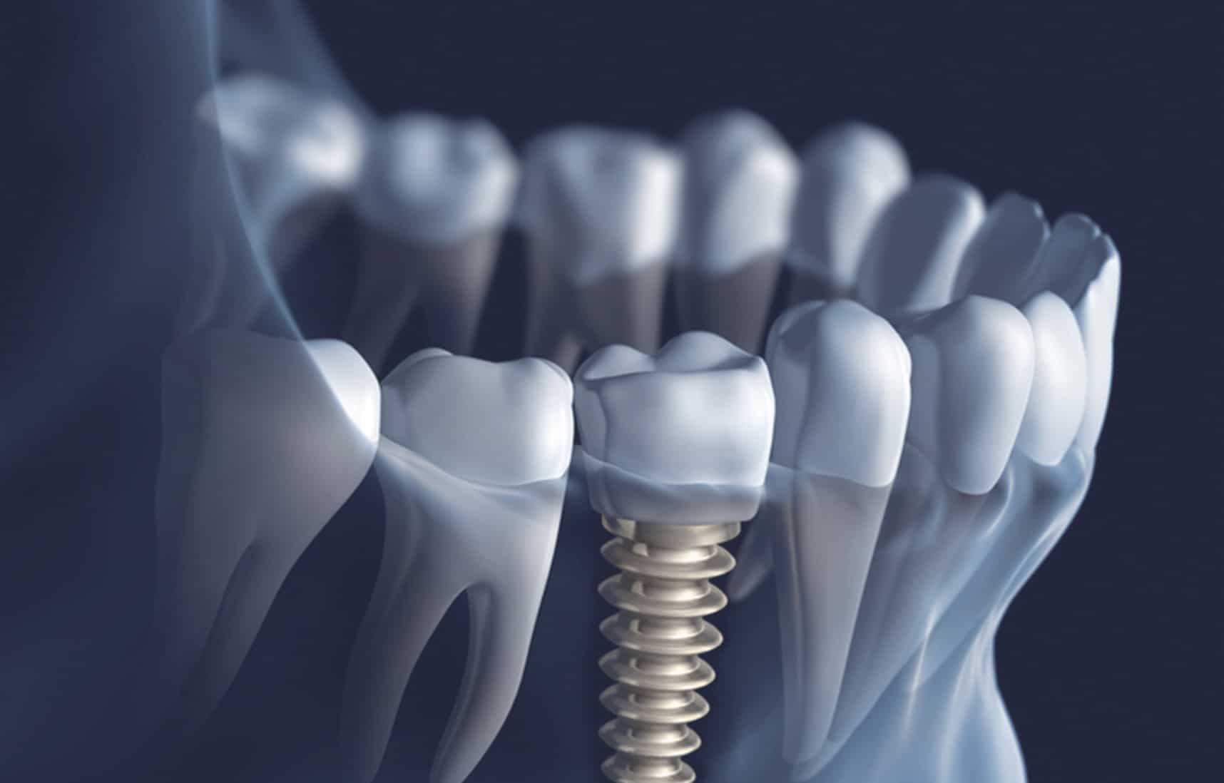 Dentus perfectus - implantology - what are dental implants?