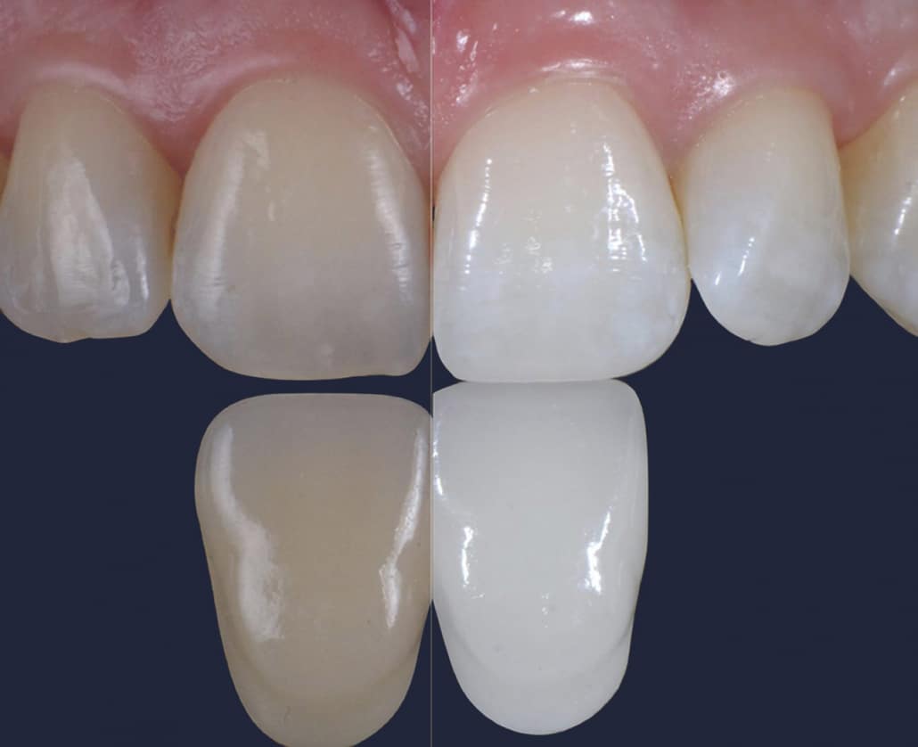 Dentus perfectus - izbjeljivanje zubi Beyond