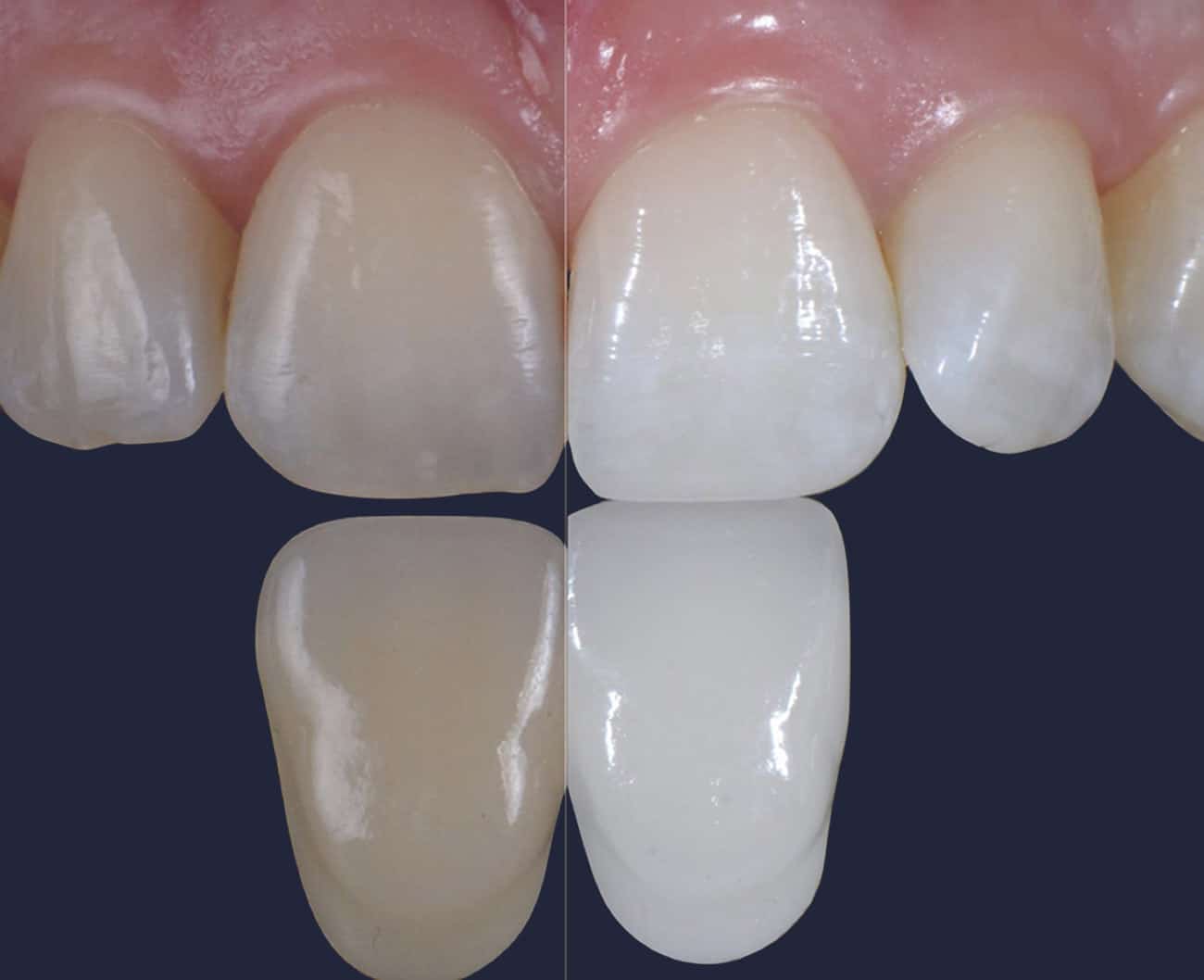 Dentus perfectus - teeth whitening Beyond