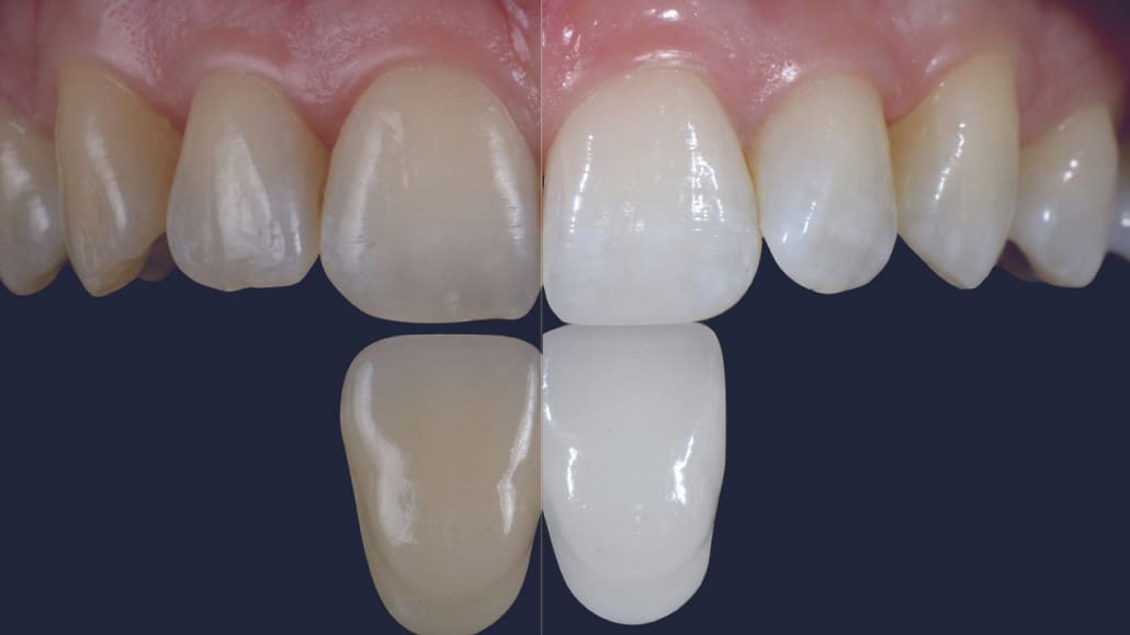 Dentus perfectus - teeth whitening before and after 1