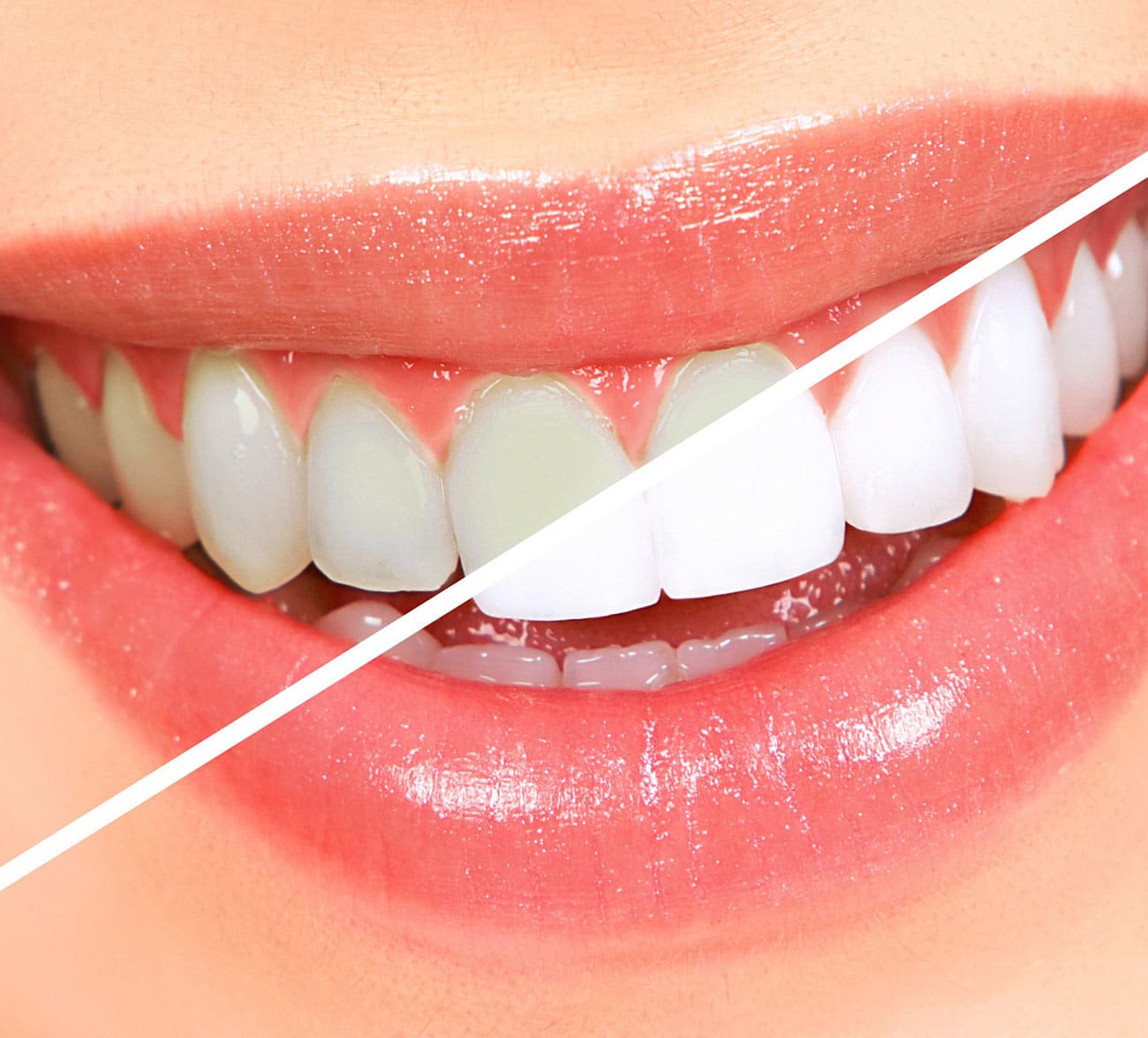 Dentus perfectus - teeth whitening before and after