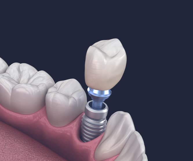 Dentus perfectus - crown on implant
