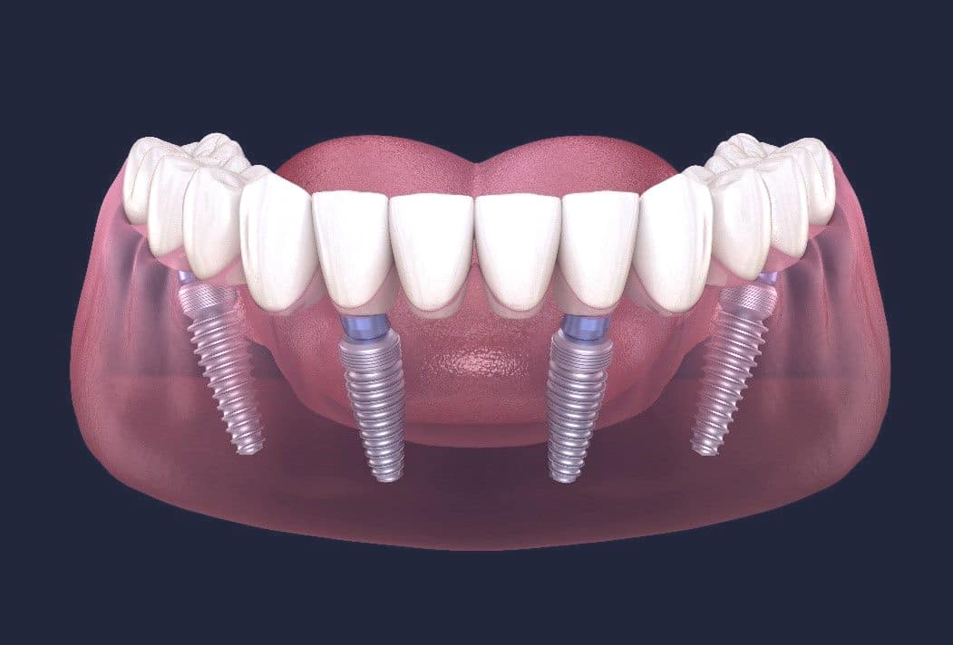 Dentus perfectus - what is all on 4?