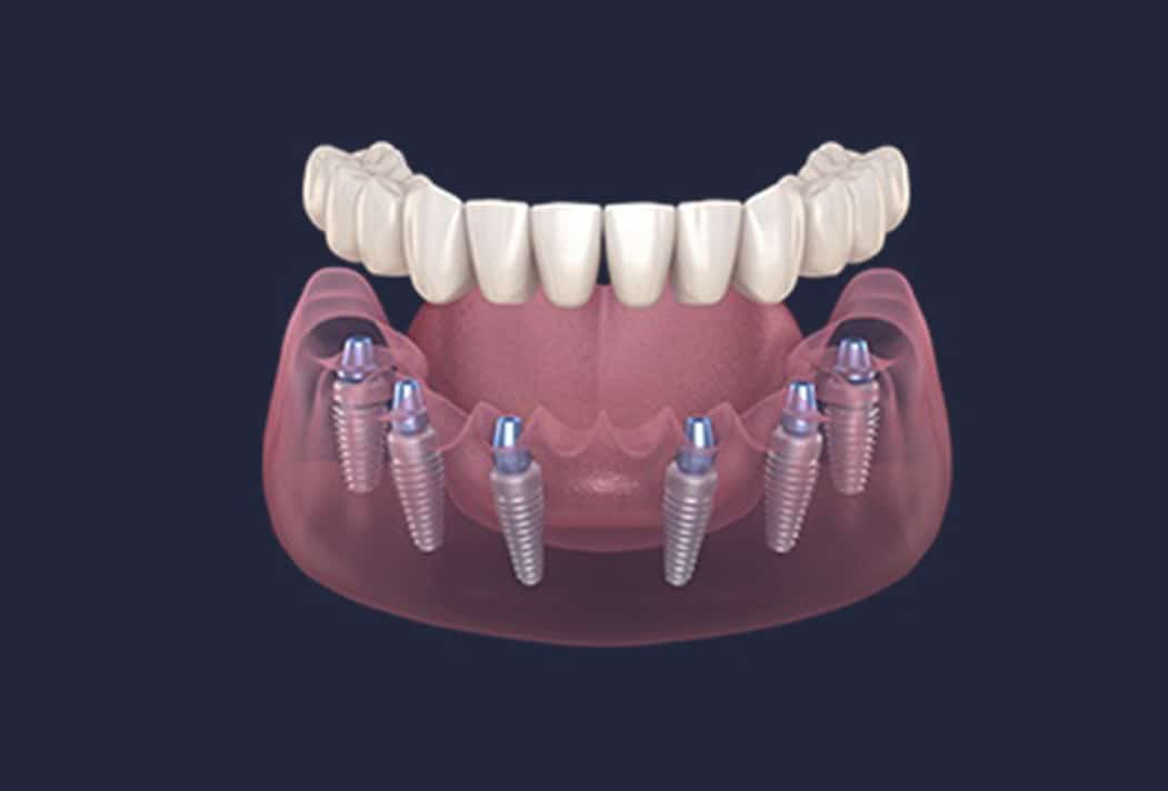 Dentus perfectus - what is all on 6?