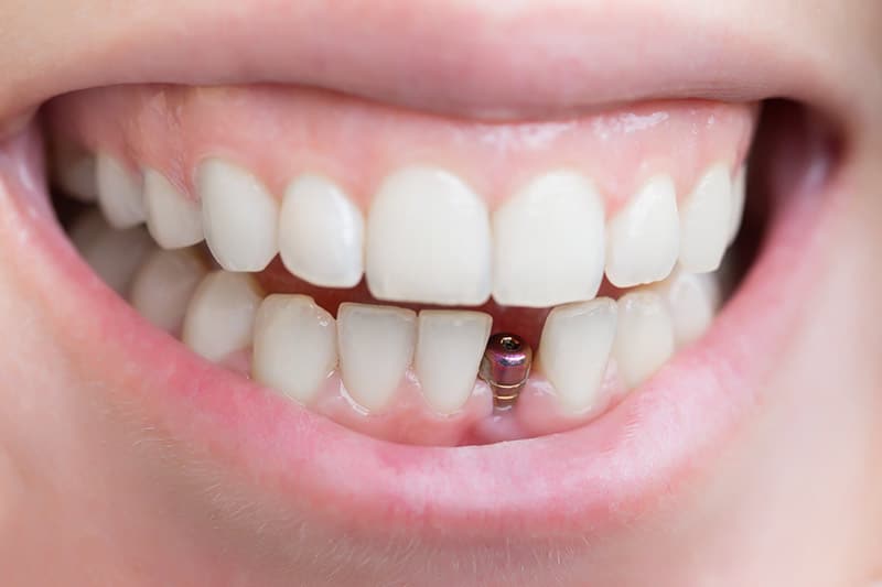 Dentus perfectus - ugradnja implantata - postupak