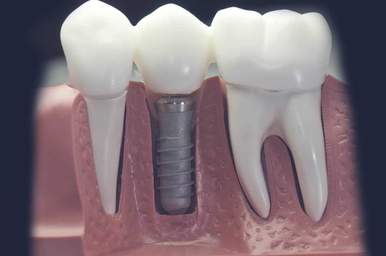 Dentus perfectus - zubne krunice na implantatima