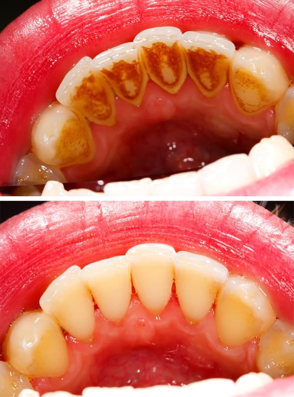 Dentus perfectus - tartar - before and after cleaning