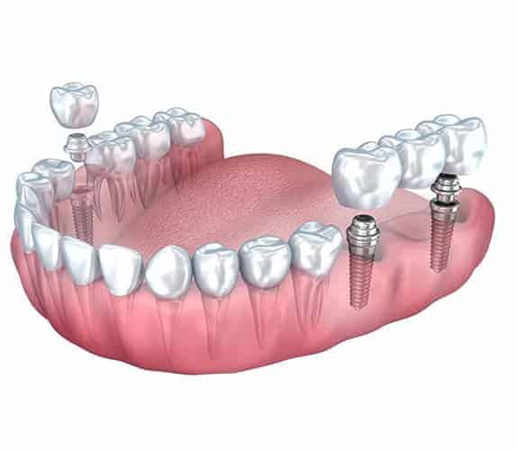 Dentus perfectsu - most na implantatima