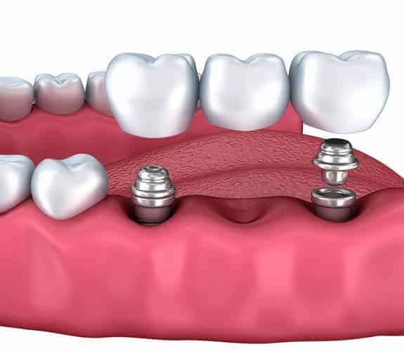 Dentus perfectus -most na implantatima