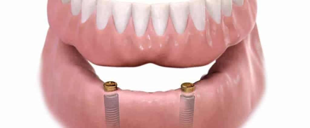 Dentus perfectus - zubne proteze