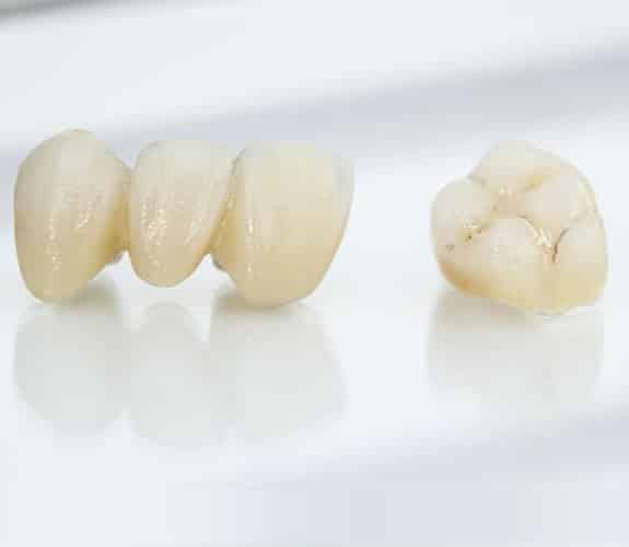 Dentus perfectus - dental bridge on natural teeth