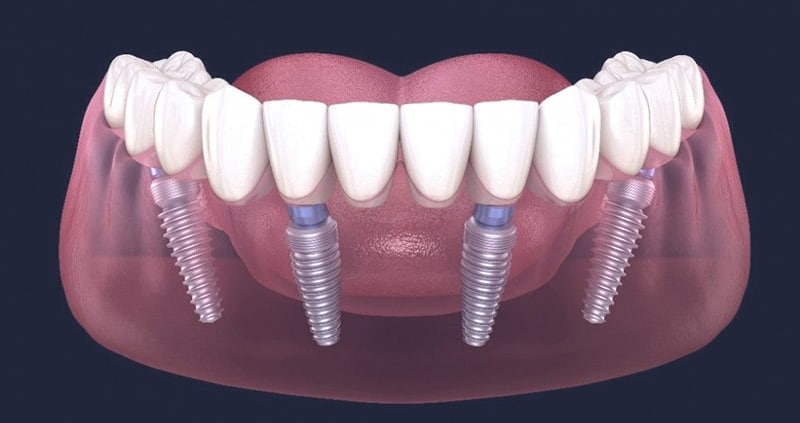 Most na 4 implantata - Dentus perfectus
