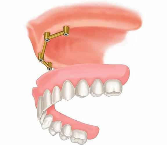 Zubna proteza 2-4 implantata 1 - Dentus perfectus