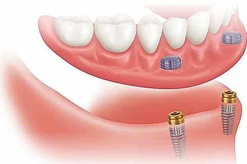 Zubna proteza 2-4 implantata - Dentus perfectus 1