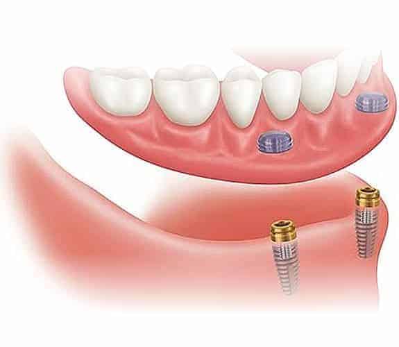 Zubna proteza 2-4 implantata - Dentus perfectus