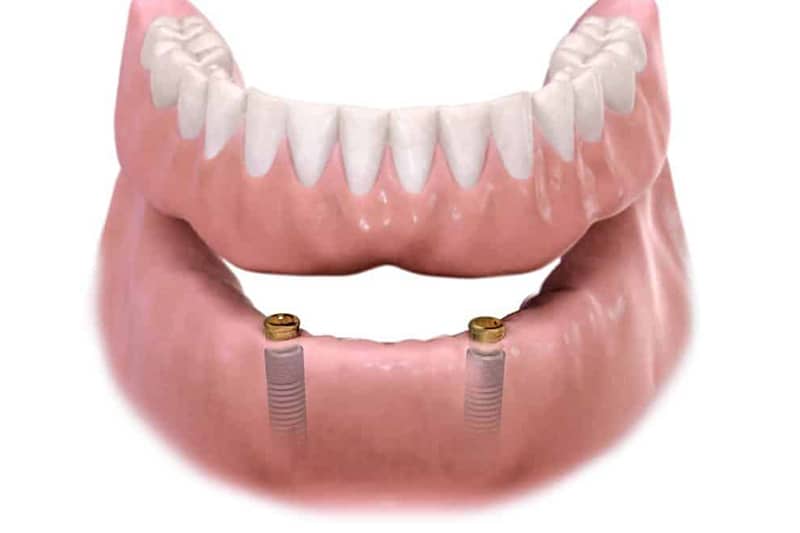 Zubne proteze 3 - Dentus perfectus