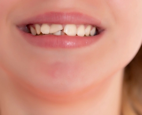 trauma zuba kod djece