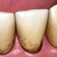 zubni plak
