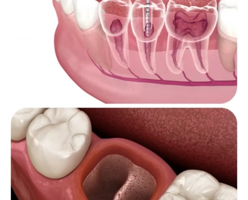3d prikaz liječenja zuba i vađenja zuba